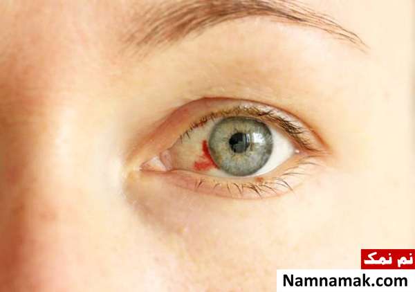 کمک های اولیه چشم ؛ ضربه ، خراش ، سوختگی و ... حین خونریزی چشم چیکار کنیم؟