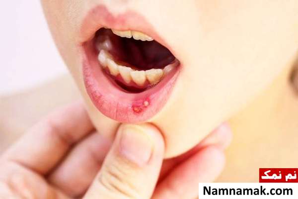آفت دهان و زبان چیست و چگونه درمان می شود