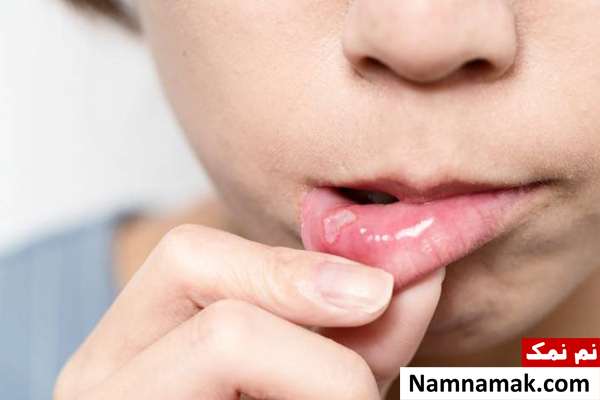 میزان احتمال ابتلا به آفت دهان