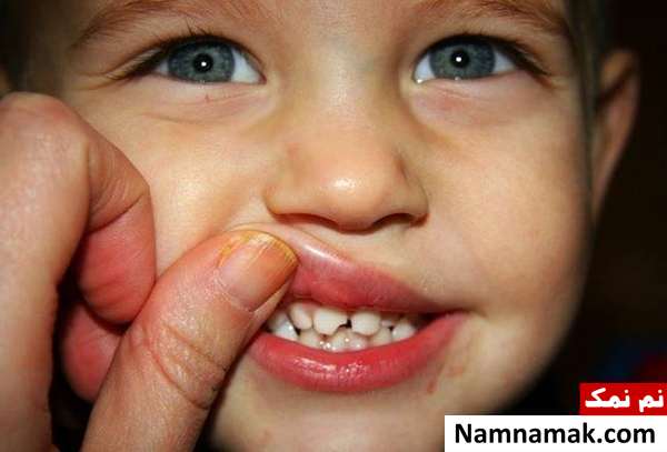 کمک های اولیه شکستگی دندان کودک