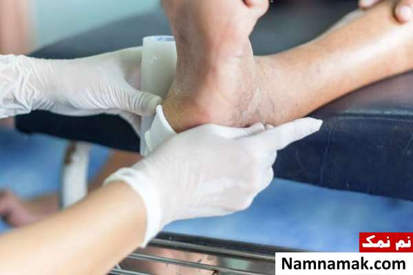 مراقبت از زخم افراد دیابتی با روش های طب سنتی چگونگی مراقبت از زخم دیابتی