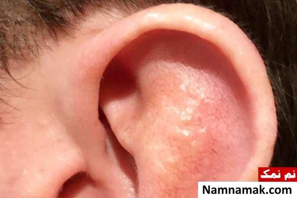 همه چیز درباره سندرم رمسی هانت + علائم و درمان علائم اصلی سندروم رمسی هانت