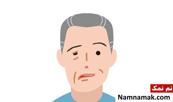 همه چیز درباره سندرم رمسی هانت + علائم و درمان عوارض مختلف بیماری رامسی هانت