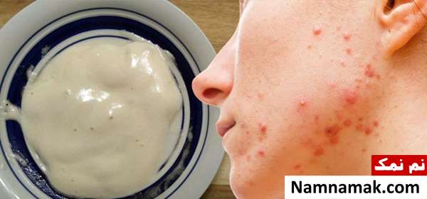 ماسک صورت برای جوش و روشن کننده پوست