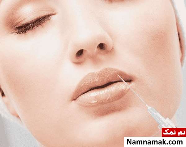 بهترین مارک ژل برای تزریق خط خنده بهترین مارک ژل برای تزریق خط خنده