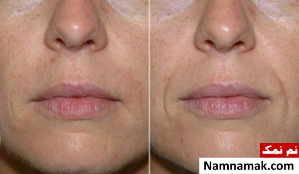 تصاویر قبل و بعد تزریق ژل خط خنده تصاویر قبل و بعد تزریق ژل خط خنده