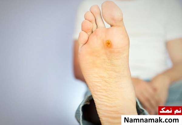 علائم دیابت روی پاها ؛ هشدارهای خطرناک مشکل در درمان زخم ها از علائم دیابت