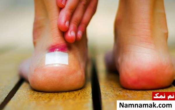 علائم دیابت روی پاها ؛ هشدارهای خطرناک زخم غیر طبیعی از نشانه های ابتلا به دیابت