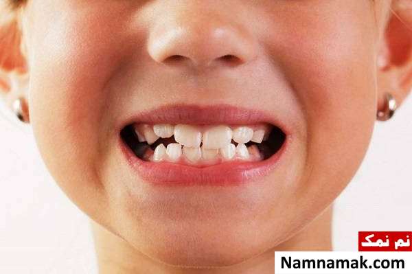 مشکل اورجت یا بیرون زدگی دندان های بالا
