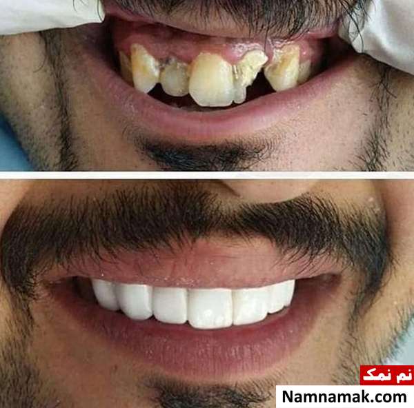 کامپوزیت متحرک دندان