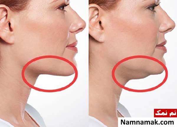 از بین بردن غبغب با جویدن آدامس چگونه غبغب را آب کنیم؟