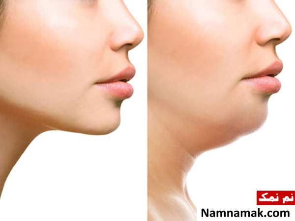 از بین بردن غبغب با جویدن آدامس چگونه غبغب را آب کنیم؟