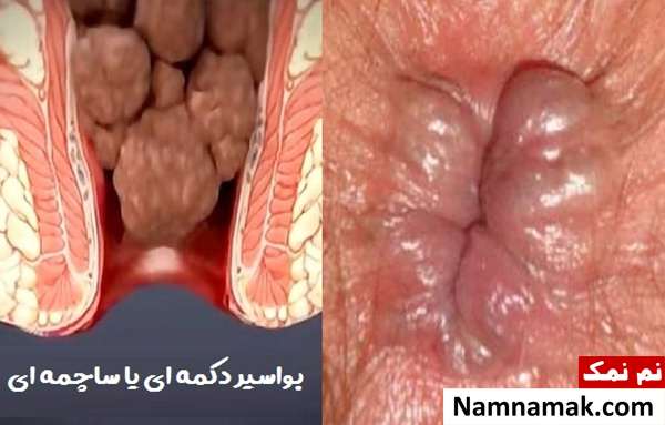 علت و علائم و نحوه درمان بواسیر دکمه ای یا ساچمه ای بواسیر دکمه ای