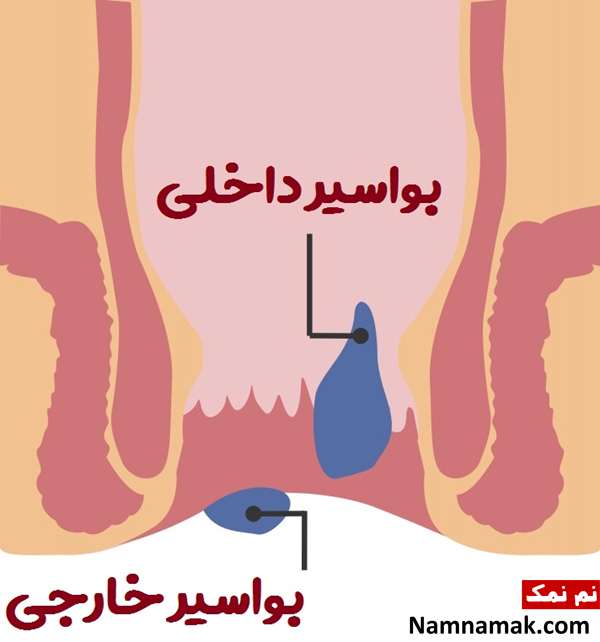 علت و علائم بواسیر خارجی یا هموروئید خارجی و درمان آن