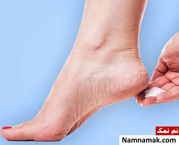 کمبود کدام ویتامین باعث ترک پا می شود؟