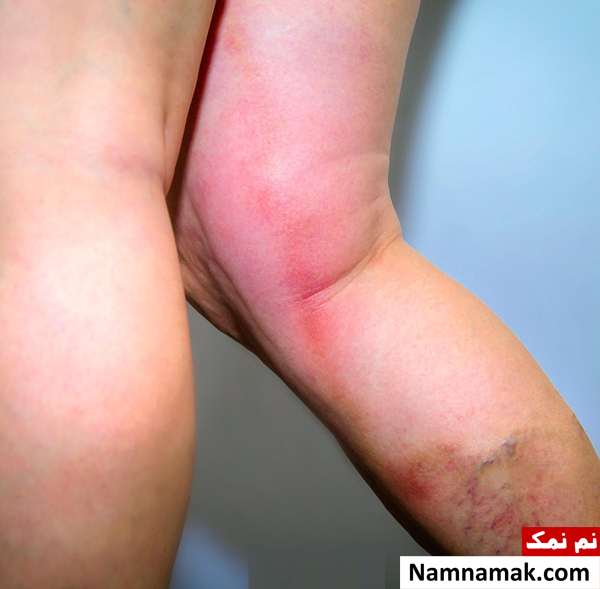 آیا آمبولی پا و لخته خون در پا باعث مرگ میشود؟
