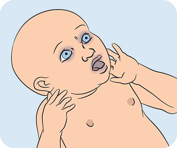 آموزش کمک های اولیه برای خفگی در نوزاد آموزش کمک های اولیه برای خفگی در کودک