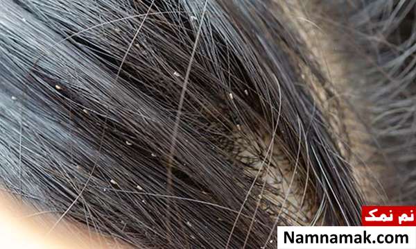 شپش از چی بدش میاد؟ شپش از چی بدش میاد؟