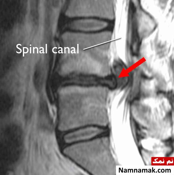 پارگی دیسک کمر خطرناک است؟