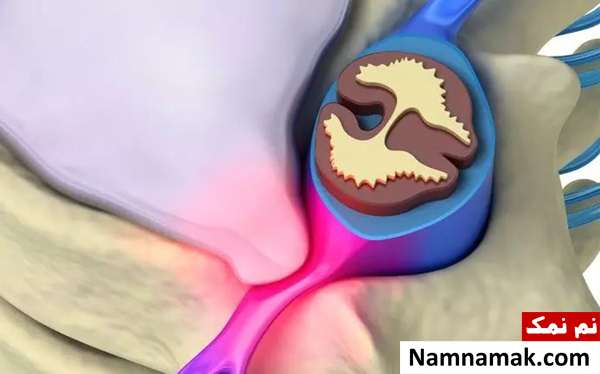 استراحت مطلق برای پارگی دیسک کمر استراحت مطلق برای پارگی دیسک کمر