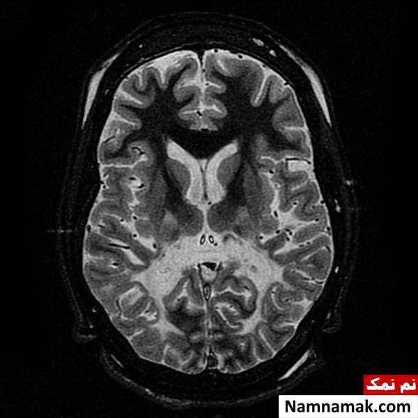 عمر بیمار لوکودیستروفی