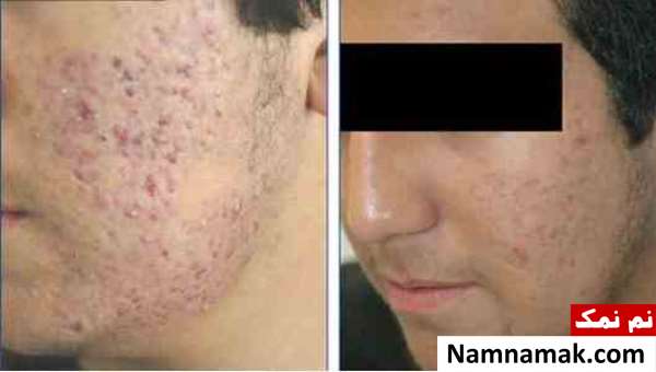 برای درمان جوش صورت چه قرصی بخوریم؟