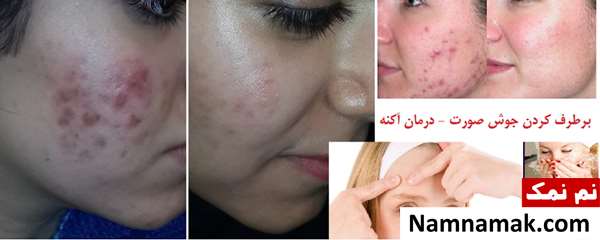 برای درمان جوش صورت چه قرصی بخوریم؟