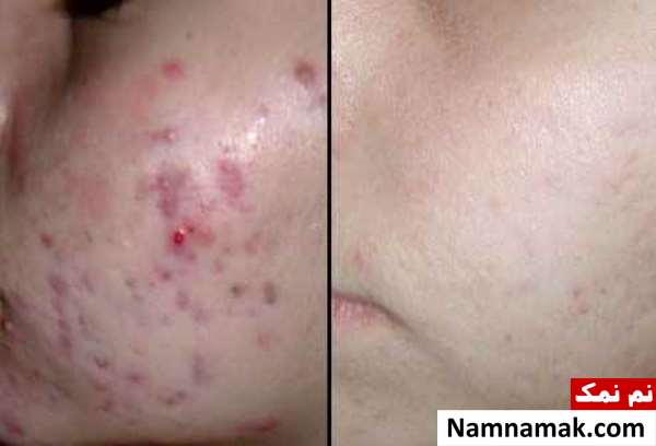 برای درمان جوش صورت چه قرصی بخوریم؟