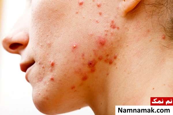 برای درمان جوش صورت چه قرصی بخوریم؟