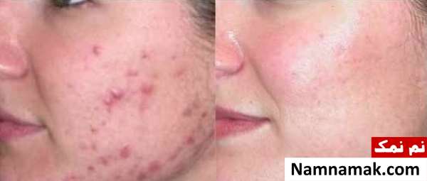 برای درمان جوش صورت چه قرصی بخوریم؟
