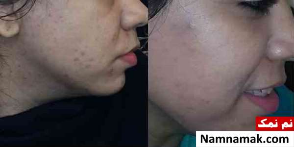 برای درمان جوش صورت چه قرصی بخوریم؟