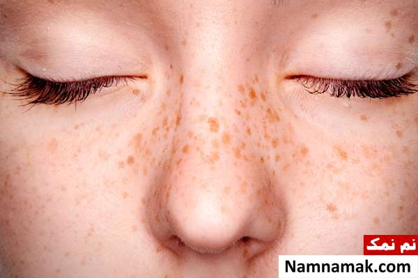 آیا قرص های ضد بارداری باعث لک صورت میشود؟ آیا قرص های ضد بارداری باعث لک صورت میشود؟