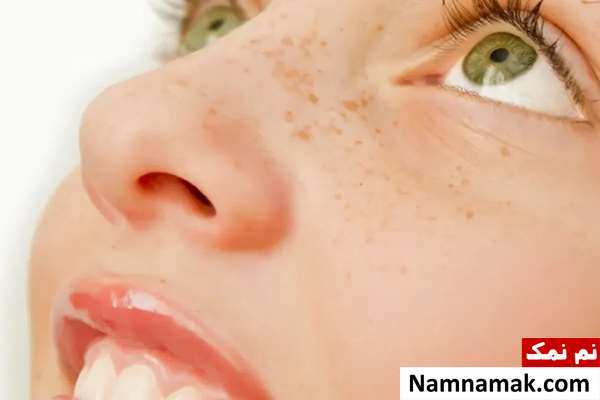 آیا قرص های ضد بارداری باعث لک صورت میشود؟ آیا قرص های ضد بارداری باعث لک صورت میشود؟