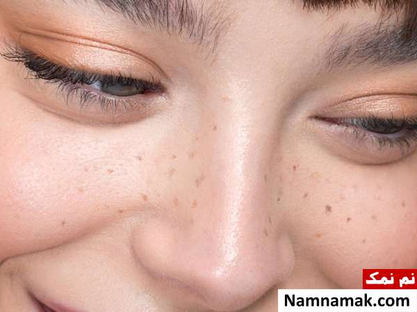 آیا قرص های ضد بارداری باعث لک صورت میشود؟ آیا قرص های ضد بارداری باعث لک صورت میشود؟