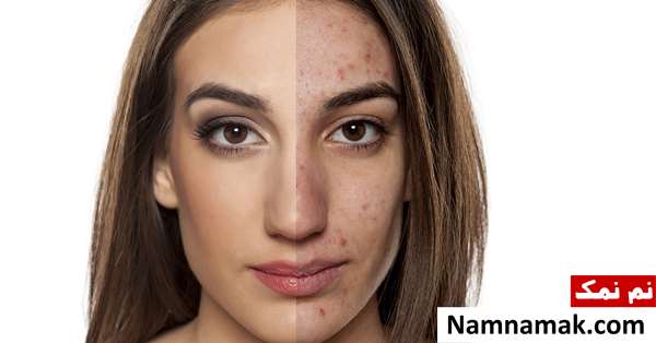 بهترین قرص ضد بارداری برای جوش صورت و آکنه بهترین قرص ضد بارداری برای جوش صورت و آکنه