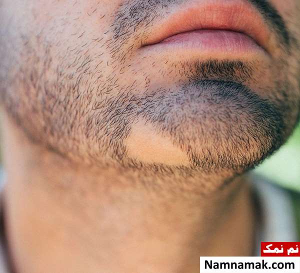 درمان خانگی قارچ ریش و سیبیل مردان درمان خانگی کچلی ریش و سیبیل مردان