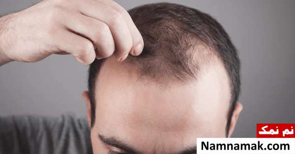 درمان خانگی ریزش مو شدید در زنان و مردان درمان خانگی ریزش مو شدید در زنان و مردان