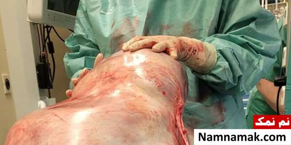 خارج کردن غده