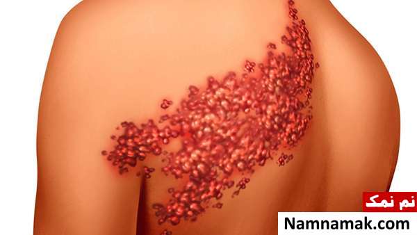 نشانه های آبله مرغان نشانه های آبله مرغان