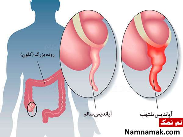 آپاندیسیت