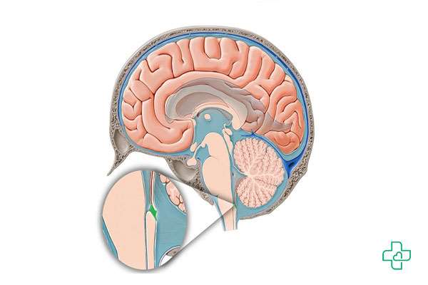 عارضه فلج مغزی نخاعی یا SCI چیست؟