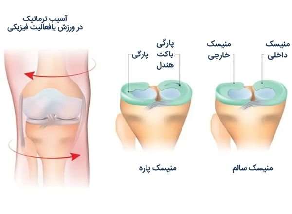 جراحی آرتروسکوپی مینیسک زانو چیست؟