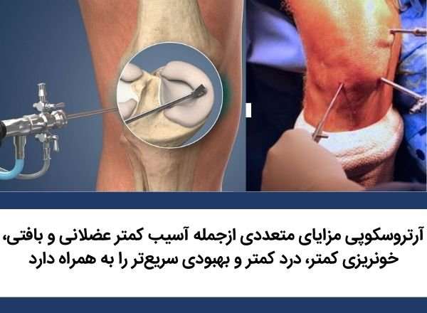 جراحی آرتروسکوپی مینیسک زانو چیست؟