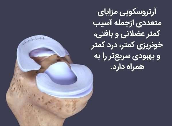 جراحی آرتروسکوپی مینیسک زانو چیست؟