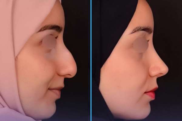 ایا عمل بینی کار درستی است؟