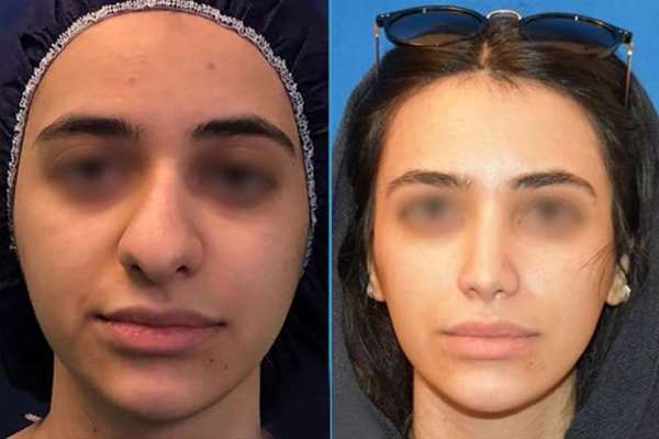 ایا عمل بینی کار درستی است؟