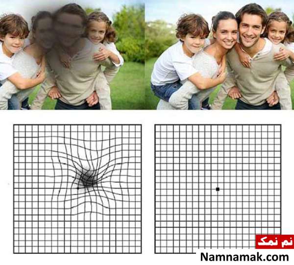 جدیدترین روش درمان دژنراسیون ماکولا