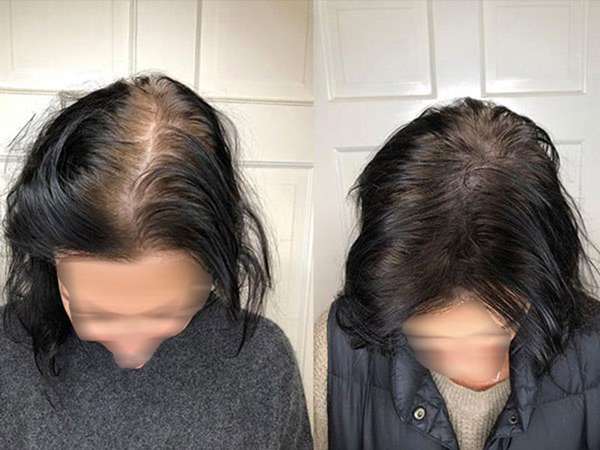 ریزش مو در زنان دلایل و راهکارهای پیشگیری