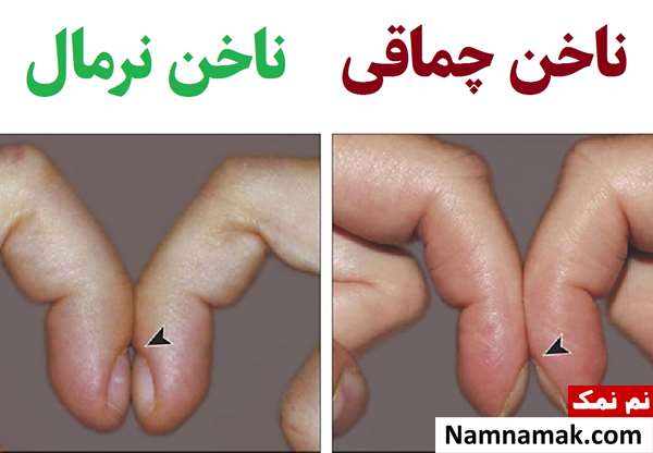 تشخیص سرطان ریه و بیماری ریوی از روی ناخن تشخیص سرطان ریه و بیماری ریوی از روی ناخن