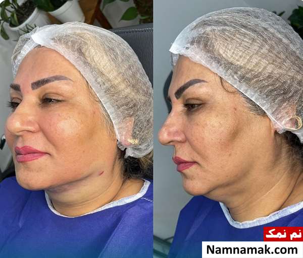 روش های از بین بردن غبغب